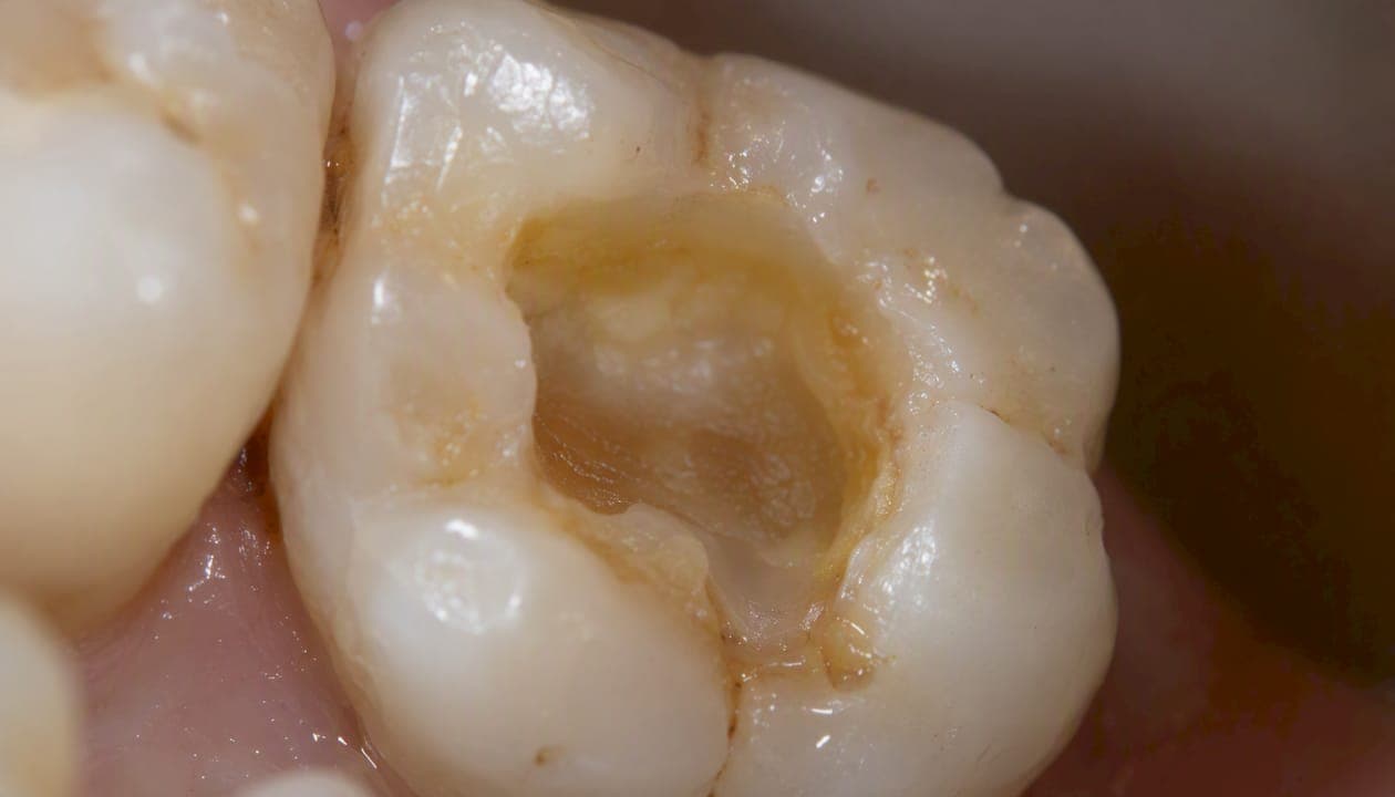 Why a Lost Filling Needs Immediate Dental Care