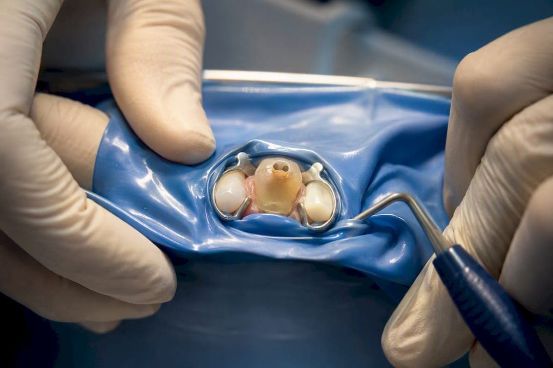 Internal Tooth Bleaching in Tallahassee: 2mm Barrier for Safer Results