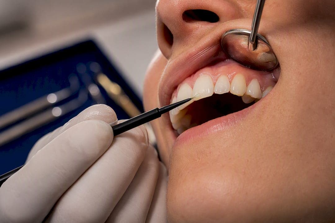 Tallahassee: Resin Infiltration and Fluoride for White Spot Treatment