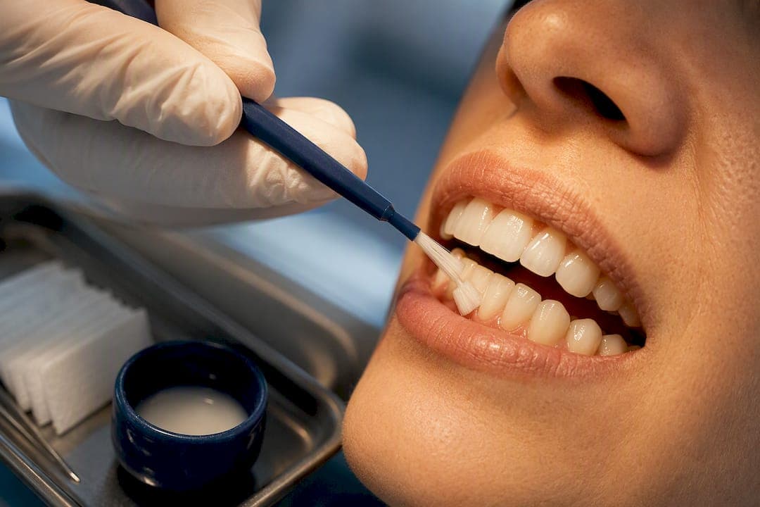 6 Risk Signs You Need Adult Fluoride Treatment
