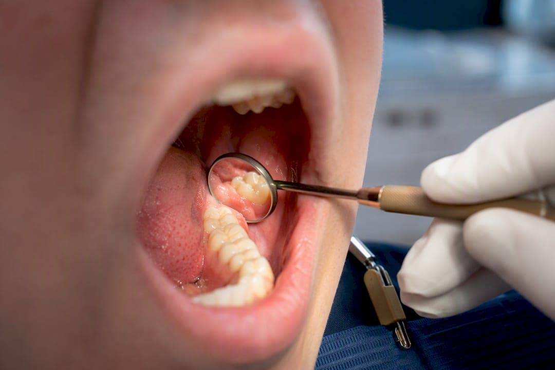Wisdom Tooth Swelling: When 48–72 Hours Means See a Dentist